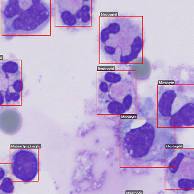 cerebrospinal fluid nucleated cell