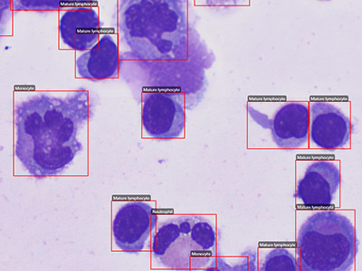 Cerebrospinal Fluid Nucleated Cells